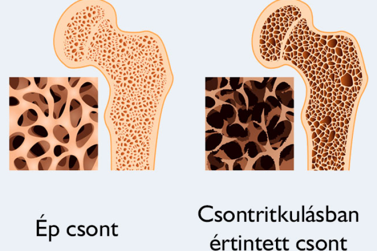 Csontritkulás szűrés az Egészségközpontban