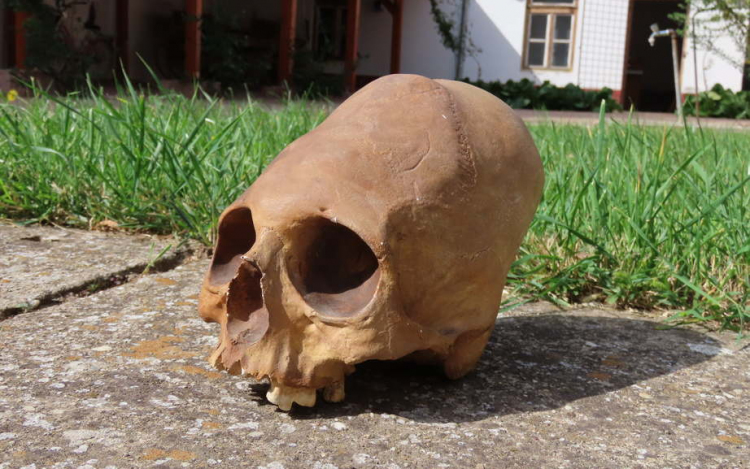Csongrádon került elő az első magyarországi torzított koponya